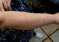 Bed Bug bites on woman's arm from hotel Find It K9 Detection NC SC certified bed bug K9